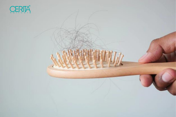 درمان ریزش موی سکه ای 